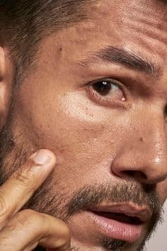 How to Reduce Acne Marks and Dark Spots Safely